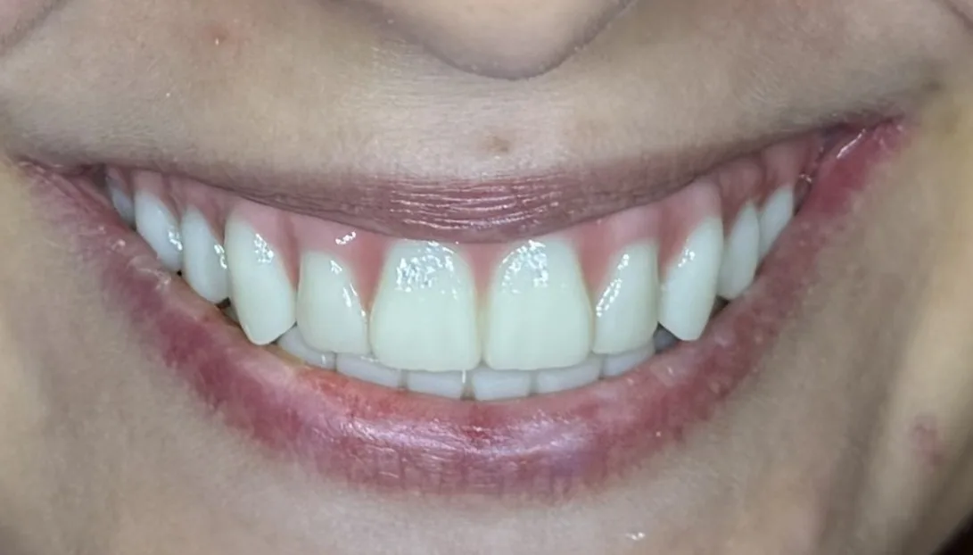 After full-arch implant treatment