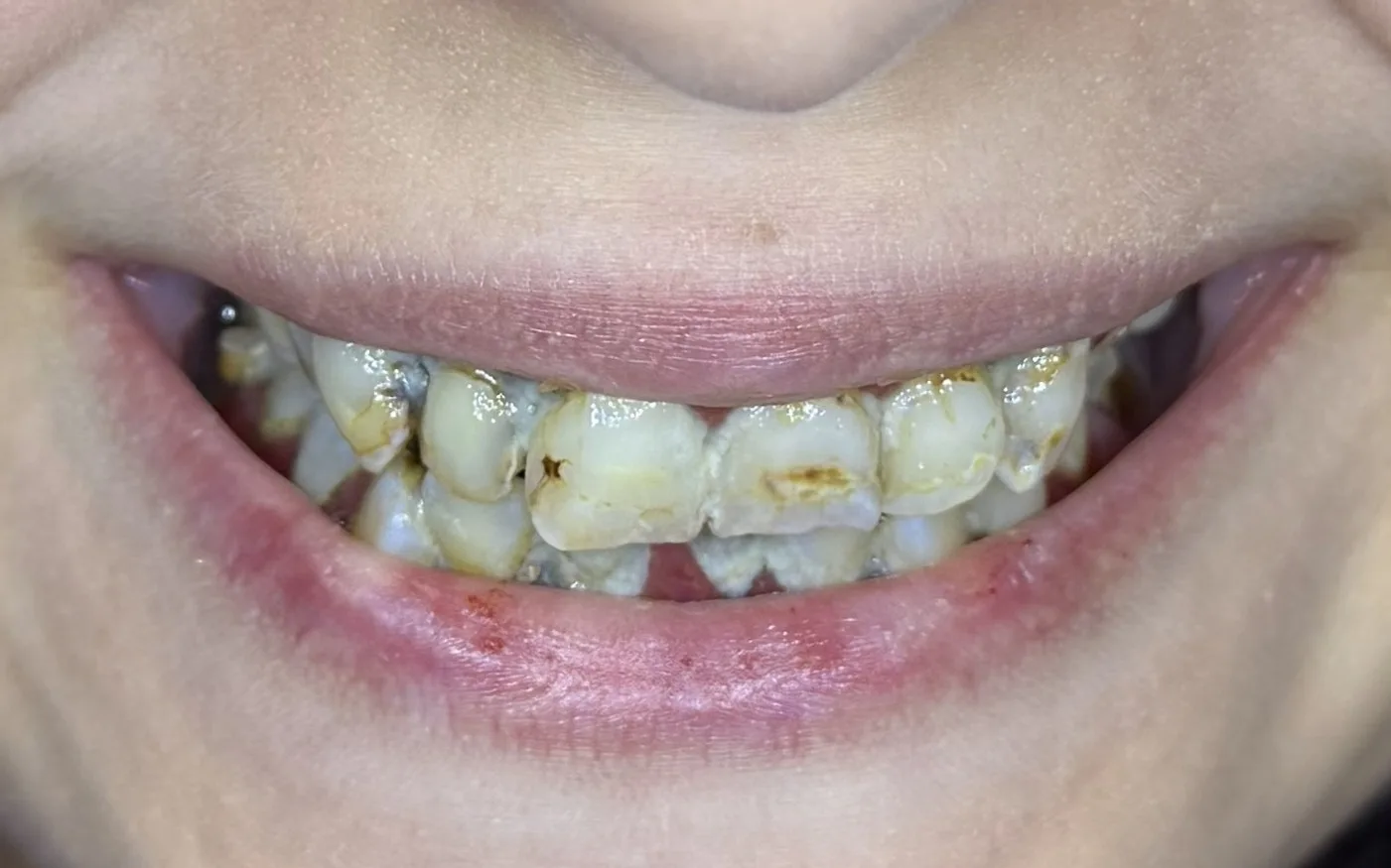 Before full-arch implant treatment